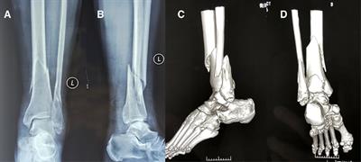 Novel Retrograde Tibial Intramedullary Nailing for Distal Tibial Fractures